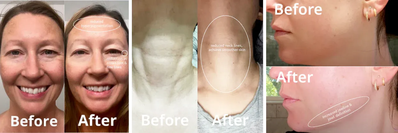 Nebulyft N1 Multipolar Micro-RF Anti-Aging Device